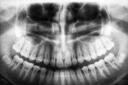 X-Ray of jaw without wisdom teeth