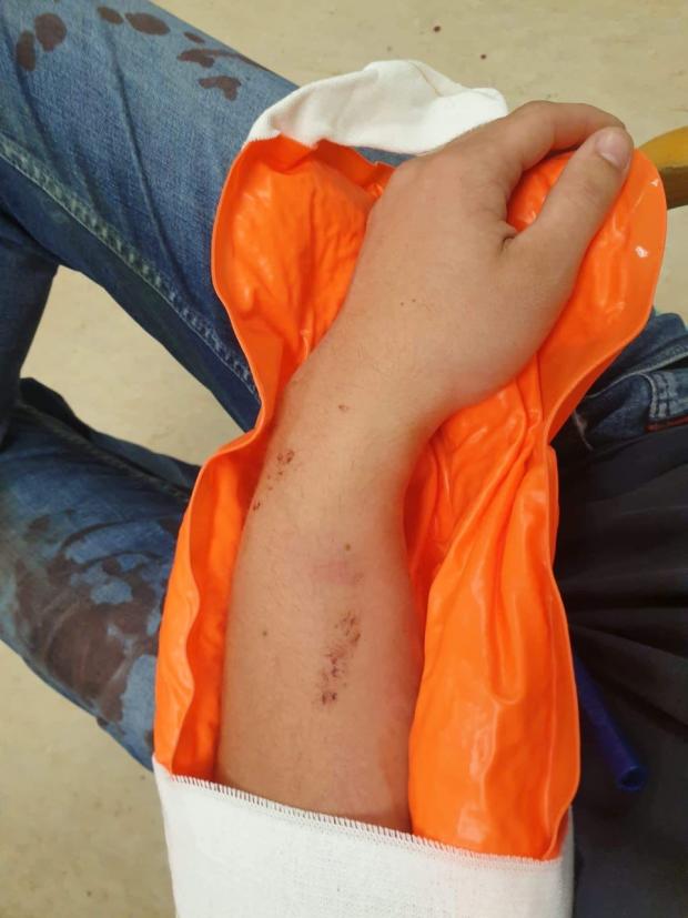 This Is Local London: Brandon's arm after the incident 